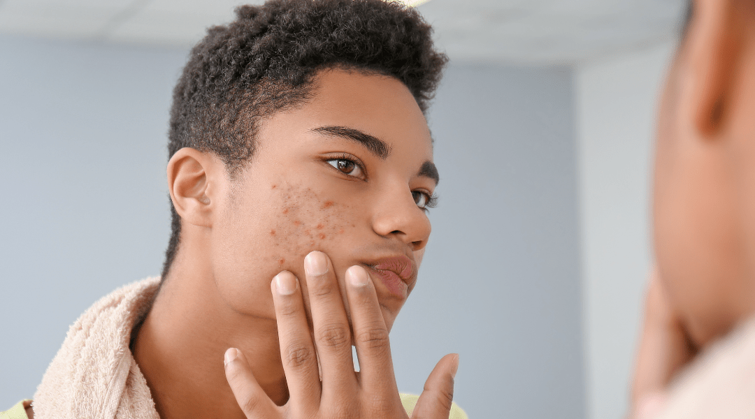 Acne and CBD: Can It Reduce Blemishes?