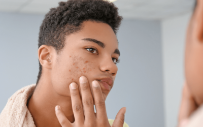 Acne and CBD: Can It Reduce Blemishes?